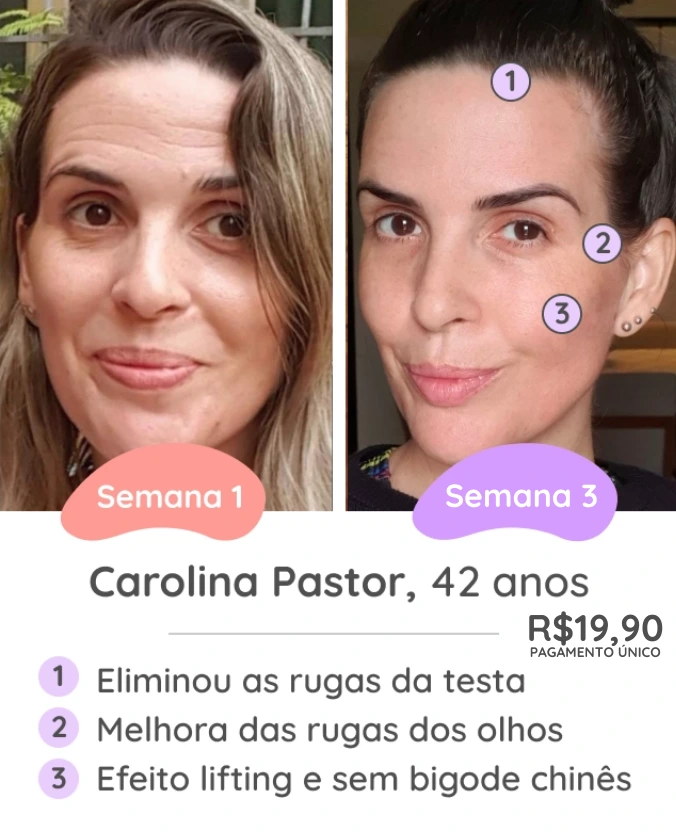 Resultado Antes e Depois - Método FaceFit